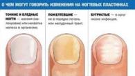 Восточная медицина: О каких болезнях можно узнать по ногтям Заболевания по внешнему виду ногтей