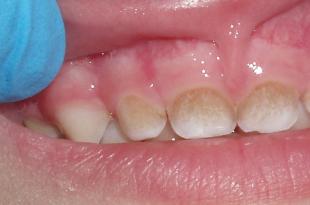 Yellow plaque on a child’s teeth - in what cases can we handle it ourselves, and when should we immediately go to the doctor?