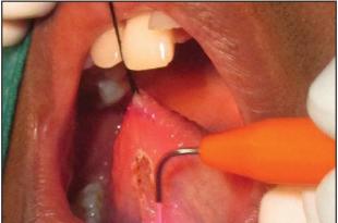 Trimming the frenulum of the tongue in children