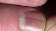 Все о появлении ямочек на ногтевых пластинах Почему ямки на ногтях