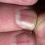Все о появлении ямочек на ногтевых пластинах Почему ямки на ногтях